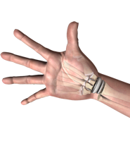 Wrist Joint Replacement (Arthroplasty)